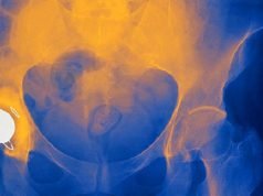 Hip Replacement hip