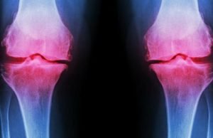 Complications on delaying a knee replacement surgery complications