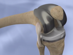 Knee Implants knee-implants.png