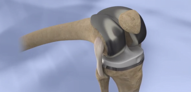 knee-implants.png