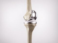 Total Knee Replacement MAKO knee-replacement-joint1.jpg