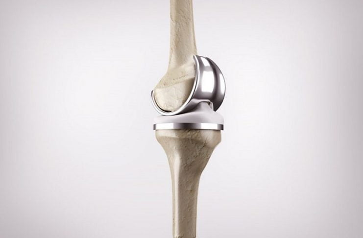 knee-replacement-joint1.jpg