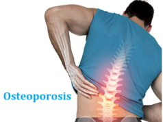 Osteoporosis Osteoporosis