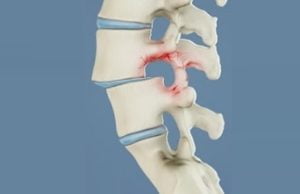 Spondylolysis