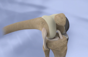 UNI-COMPARTMENT KNEE REPLACEMET