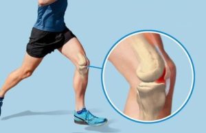 रनर्स नी : वजन बढ़ने से घुटने हो सकते है क्षतिग्रस्त