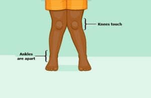 Knock Knee knock-knee-photo