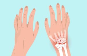 Psoriatic Arthritis Symptoms, Causes, Conditions and Treatment