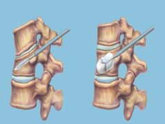 Vertebroplasty vs. Kyphoplasty: Which Procedure is Right for You? Best Orthopedic Surgeon in patna
