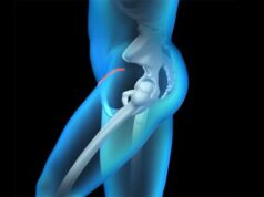An Introduction to Bikini MIS Hip Replacement: What You Need to Know