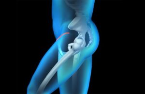 An Introduction to Bikini MIS Hip Replacement: What You Need to Know