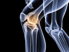 Understanding the Risks of Periprosthetic Infections After Knee Surgery