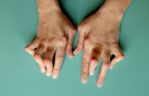 Understanding Rheumatoid Arthritis: Signs, Symptoms, and Comprehensive Care Rheumatoid arthritis treatment
