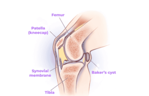 Baker’s Cyst: Causes, Symptoms, and Effective Treatment Options at AJRC