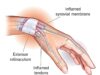 De Quervain’s Tenosynovitis: Causes, Symptoms, and Modern Treatment Insights